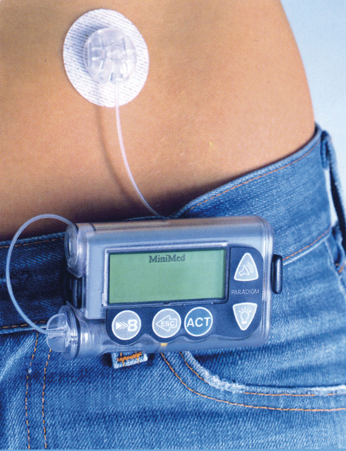 bomba de insulina para diabeticos tipo i en mexico - www bomba de insulina para diabeticos tipo i en mexico - www